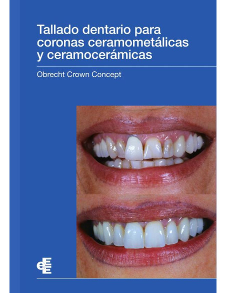 Tallado dentario para coronas ceramometálicas y ceramocerámicas:Obrecht Crown Concept